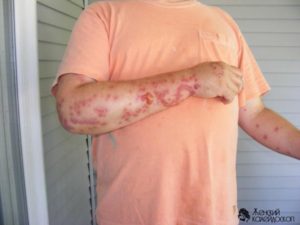 enfermedades de chinches