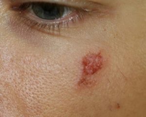 Enferemdades de las chinches